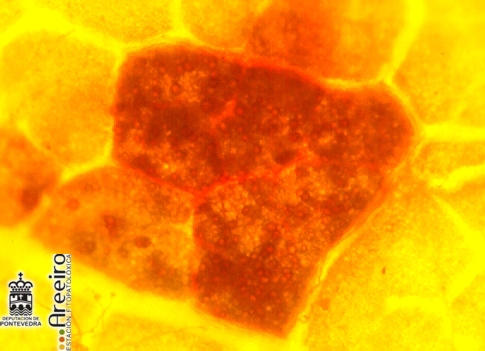 Mildiu - Mildew - Mildiu >> Plasmopara vitícola (Mildiu de la viña) - oosporas en una mancha en mosaico.jpg